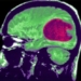 artificial intelligence can treat brain strokes faster and more accurately 128558