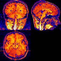 brain 1