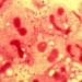 brain meningitis and preventive measures 6079