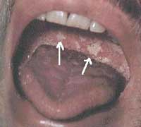 Oral Candidiasis