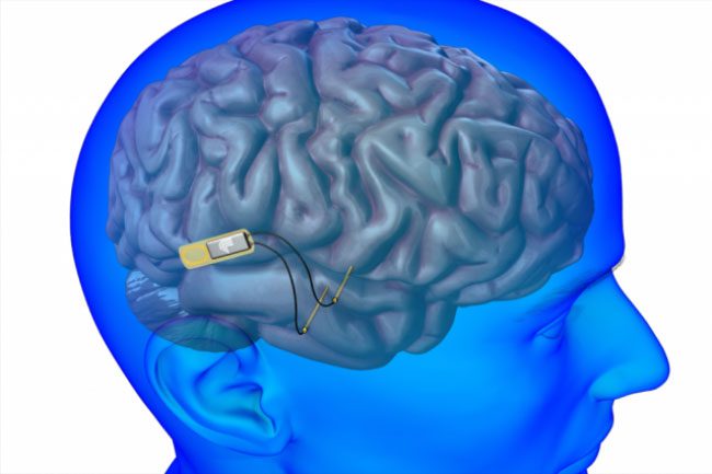 Inserting electronic chips into the human body is no longer unusual