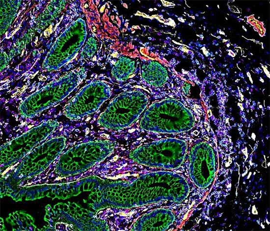 In this image, the green-marked regions represent cytokeratins.