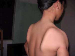 A case of Delta muscle atrophy in Ha Tay.