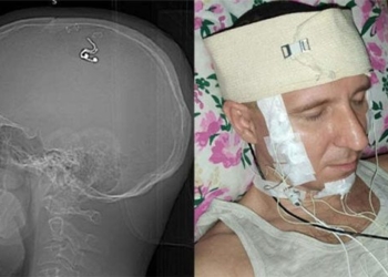 dentist declares brain surgery at home 128770