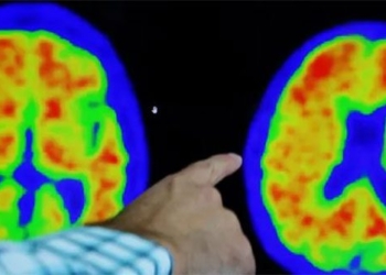 donanemab drug breakthrough in alzheimers treatment 128846