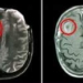 early detection of brain tumor in children 5571