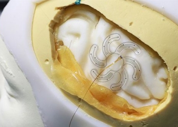electrical stimulation therapy reveals surgical options for nervous system treatment with minimum invasive 127429