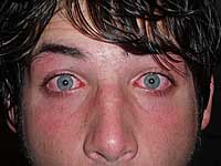 Burned Eye