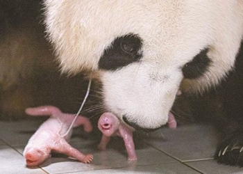 first ever conjoined twins born in south korea 128585