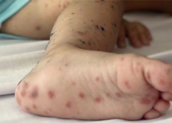 first oral hand foot vaccine in vietnam effective 96 8 128833