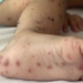 first oral hand foot vaccine in vietnam effective 96 8 128833