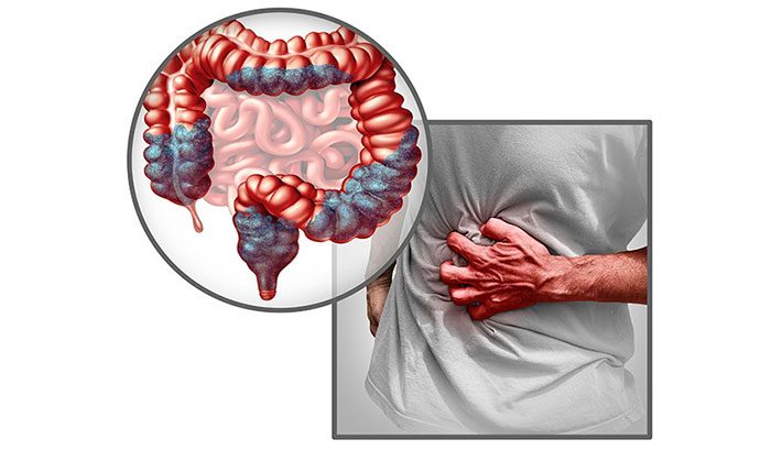 The hallmark symptom of Irritable Bowel Syndrome is recurrent abdominal pain.