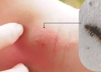 how to detect and treat later stage psoriasis 127597