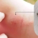 how to detect and treat later stage psoriasis 127597