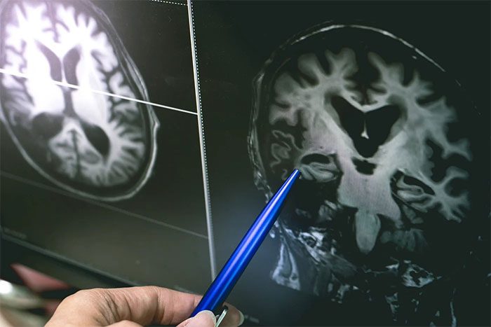 Brain Scan Results