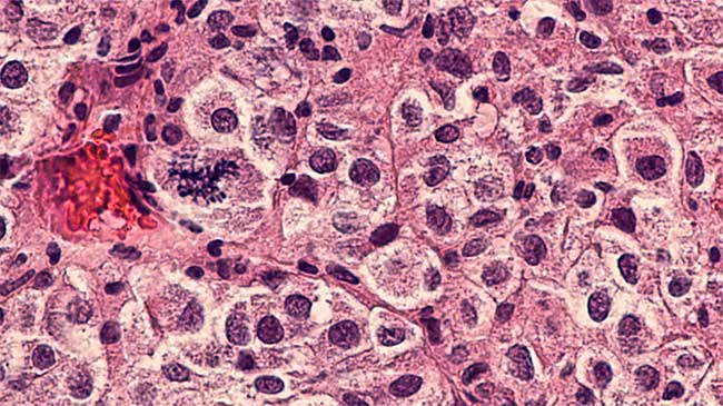 Cancer tumor developing in the body