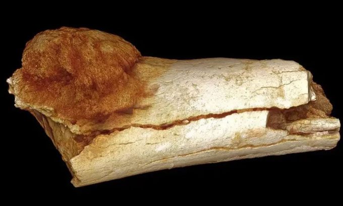 Tumor in the toe bone of an individual related to modern humans.