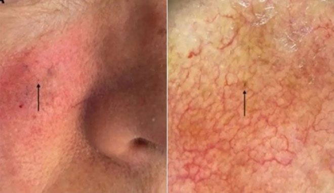 The tumor is so small it is nearly undetectable by the naked eye
