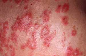 Lupus Disease