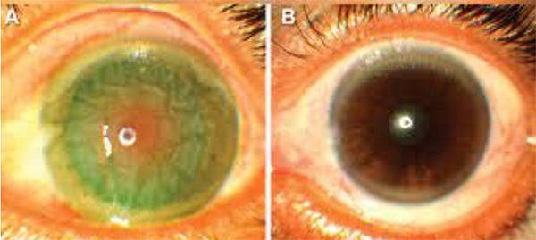 After exposure to snake venom, the victim's eye (left) will gradually become cloudy and lose its ability to see.