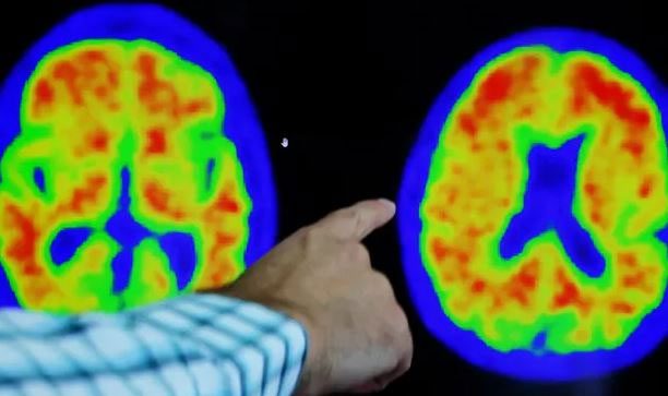 PET scan of an Alzheimer's patient's brain.