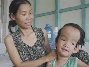 Patient On Vinh Hang (7 years old, Ho Chi Minh City) recently underwent surgery to place a shunt on May 29 at Children's Hospital 1