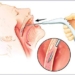 new treatment technology stop snoring while sleeping day 5796