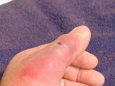 Bite after 1 week