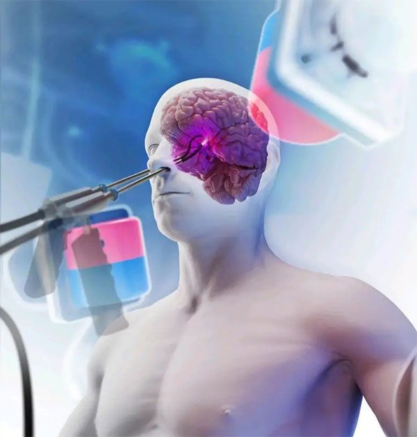 First-time use of two magnetically controlled soft robots for anterior brain surgery.