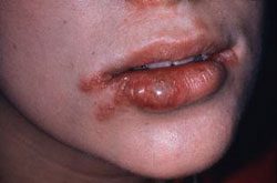 Herpes Mouth Disease