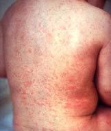 Rubella