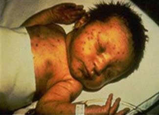 rubella pregnancy risks birth defects 5175