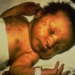 rubella pregnancy risks birth defects 5175