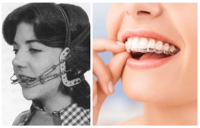 Braces then and now have seen improvements that are hard to recognize