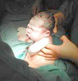 C-section delivery method