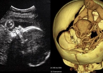successful surgery for a rare brain tumor 127332