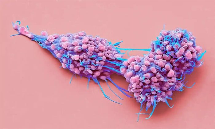 Ovarian cancer cells displayed under a microscope.