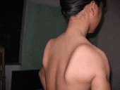 Patient with Delta muscle atrophy