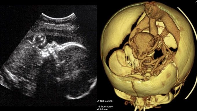 Fetus with Galen vein malformation (VOGM)