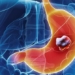 top 5 genetic cancer types high risk 127204