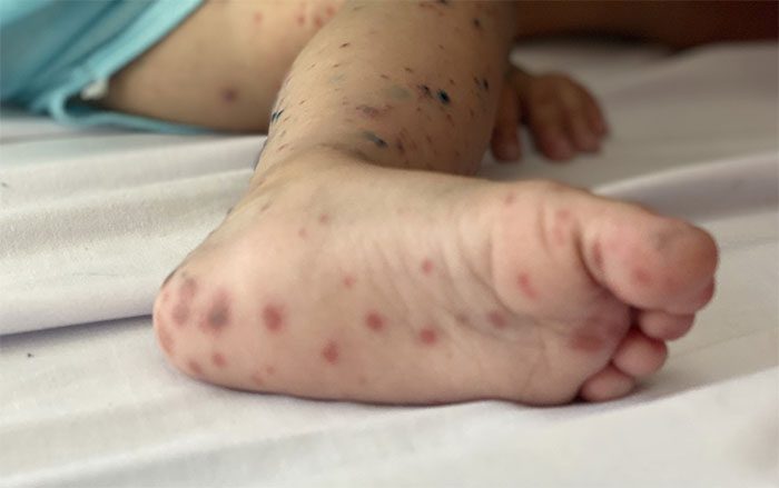 Rash on the foot of a child with hand, foot, and mouth disease.