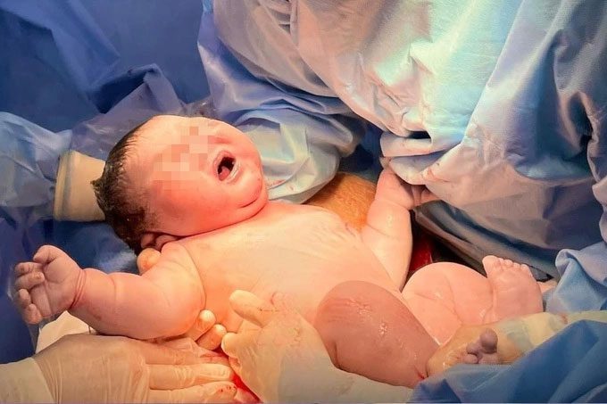 Newborn babies are stimulated by doctors to cry.