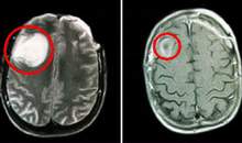 Brain Tumors