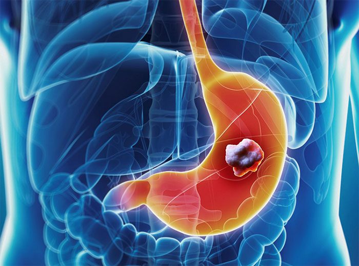 Stomach Cancer