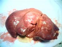 Image of liver cancer