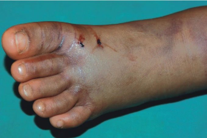 Snake bites can lead to serious consequences
