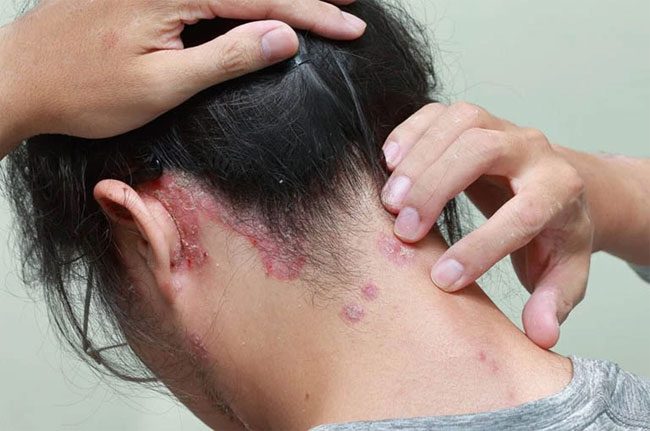 Regularly wearing damp helmets can cause itchy scalp, significant hair loss...