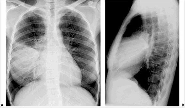 Mycoplasma pneumonia can cause various complications, such as lung consolidation.
