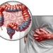what is intestinal stimulation 127697
