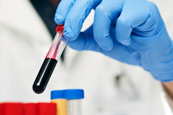 Abnormal levels of certain proteins linked to dementia risk.